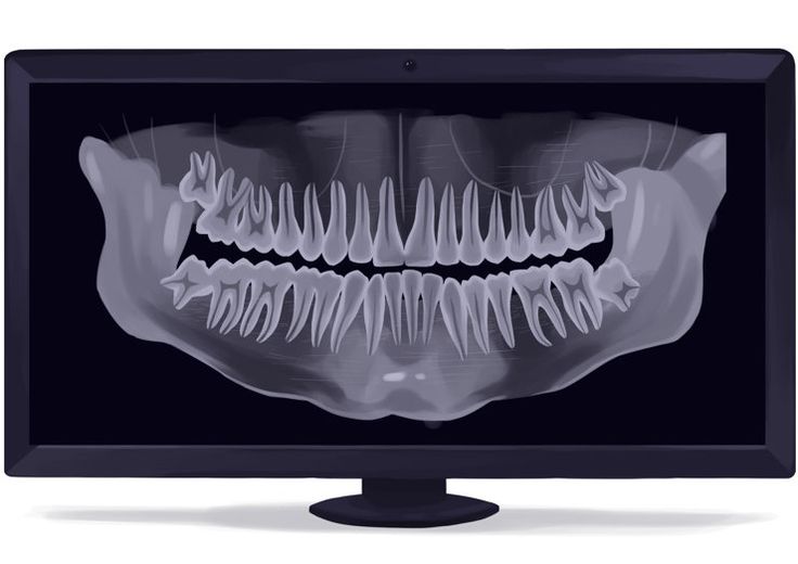 Dental X-Ray