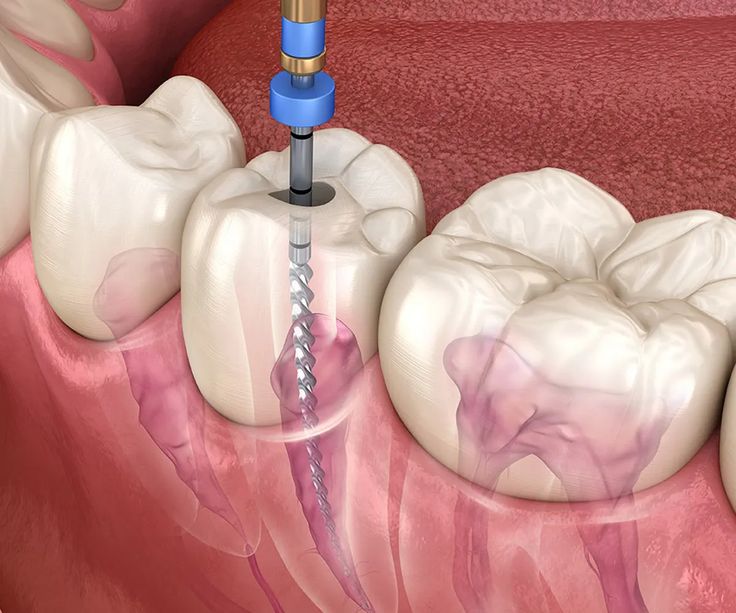 RCT (Root Canal Treatment)