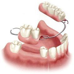 Removable-Partial-Denture-supreme-dental-clinic-post-7